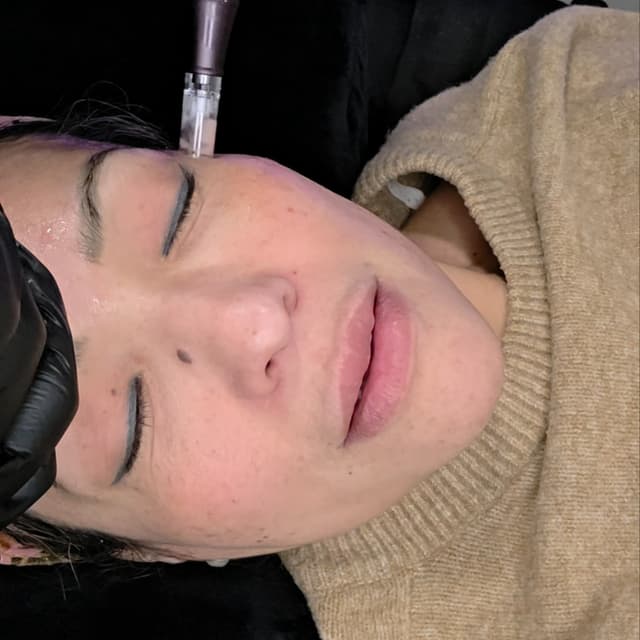 Microneedling at Uhane Esthetics in Sparks, NV