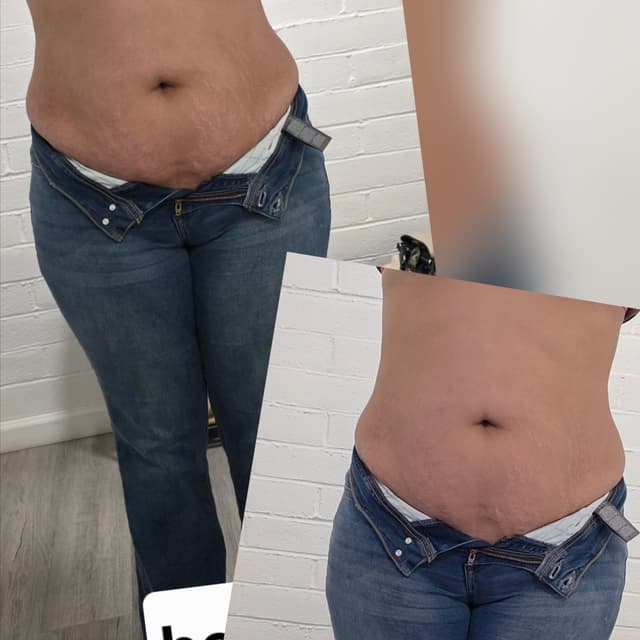 Body Sculpting at Uhane Esthetics in Sparks, NV